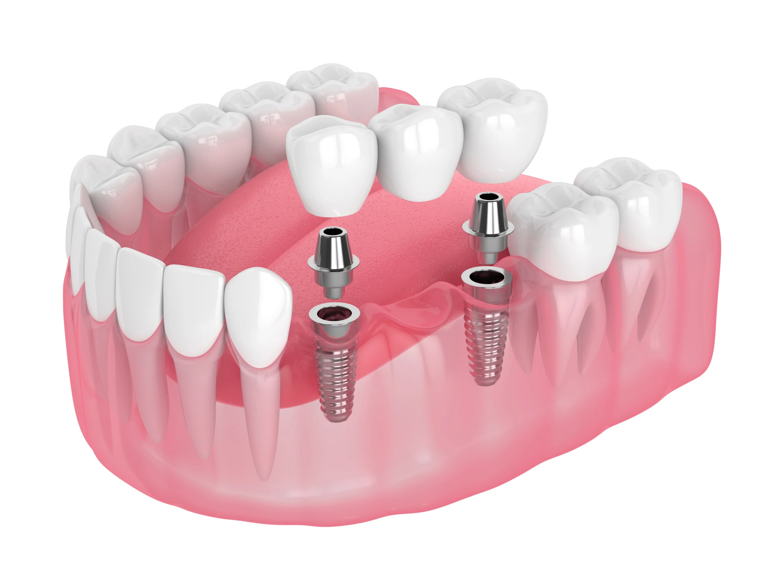 dental bridges in stouffville